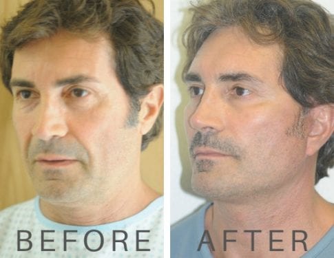 What Types of Facelift Surgery Are There for Men? | Beverly Hills