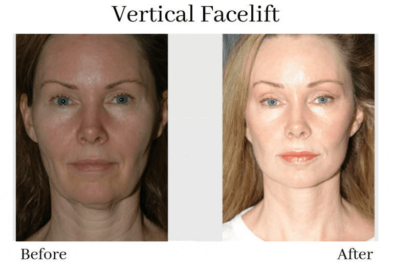 How the Vertical Facelift is Revolutionizing Facial Rejuvenation  Beverly Hills Facelift Institute