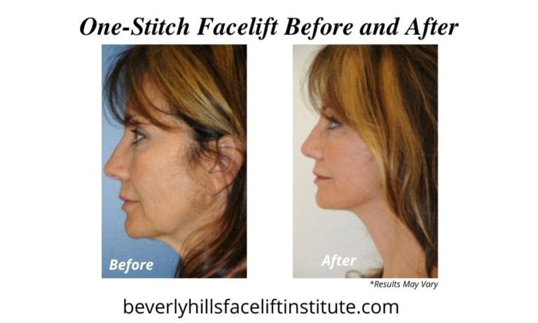 Your Complete Recovery Guide to a One-Stitch Facelift | Beverly Hills ...