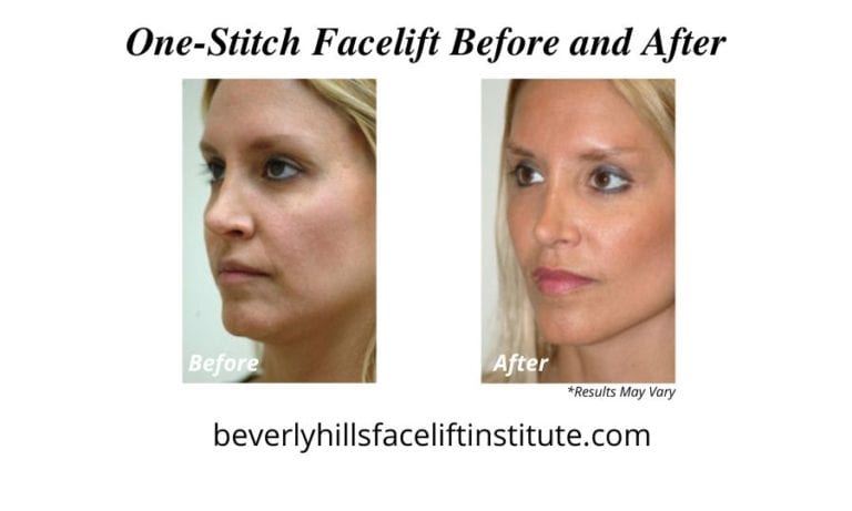 Your Complete Recovery Guide to a One-Stitch Facelift | Beverly Hills ...